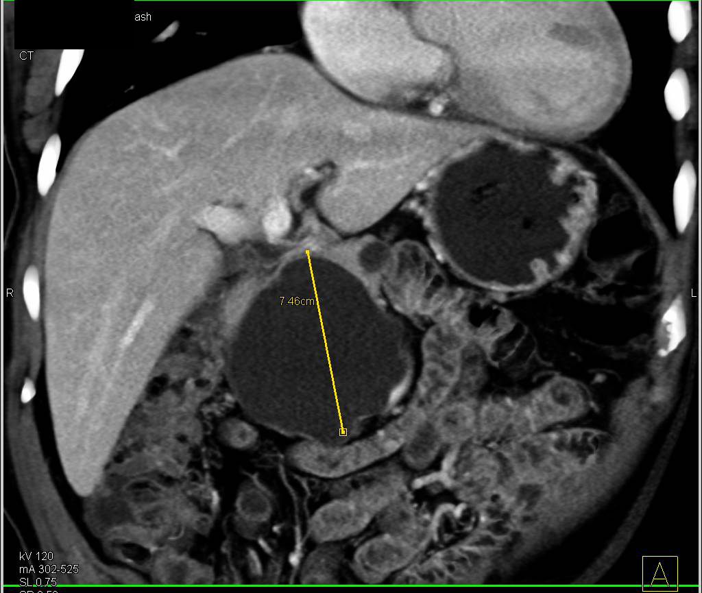 Pancreatic Pseudocyst - CTisus CT Scan