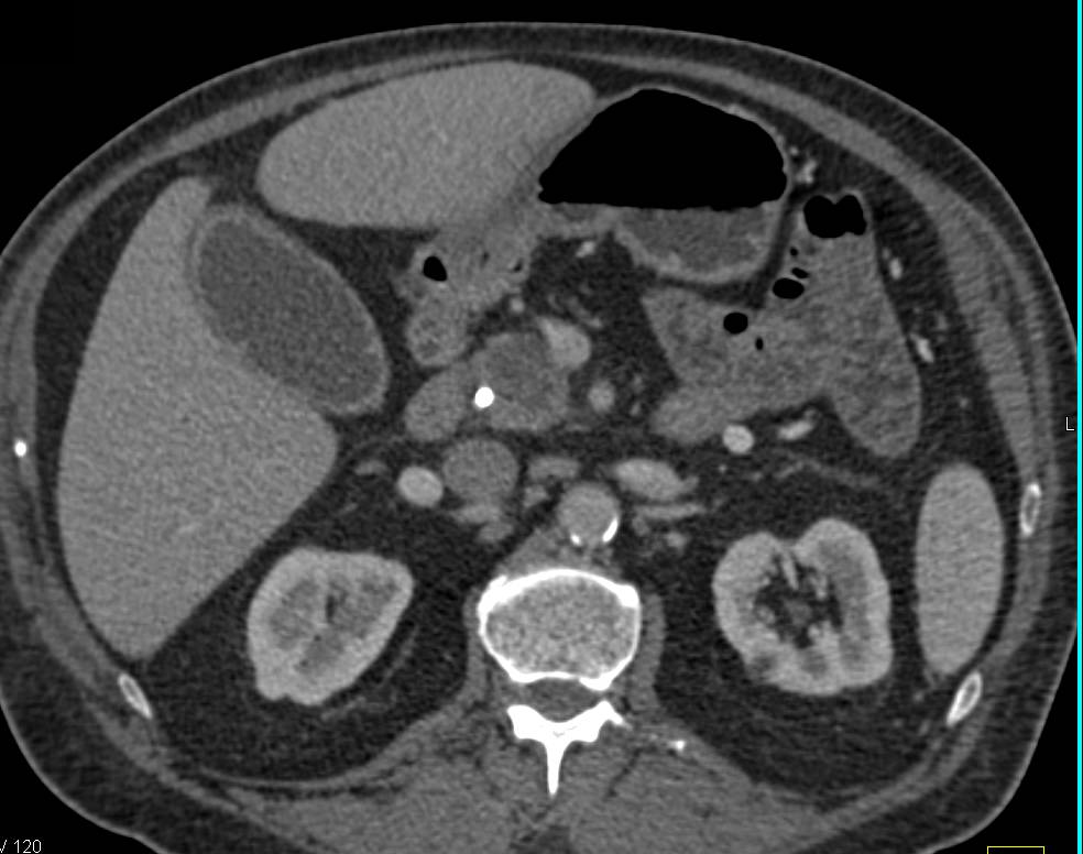 Pancreatic Adenocarcinoma with Adrenal Adenoma - CTisus CT Scan