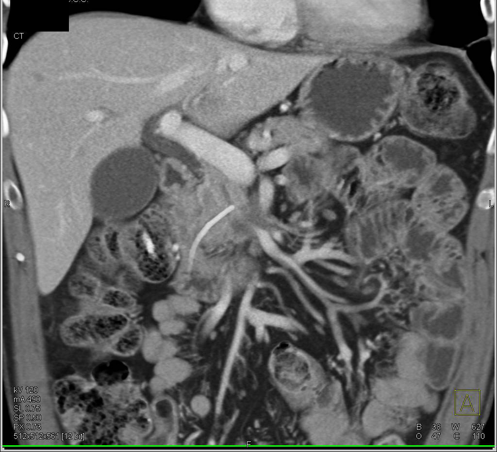 Adenocarcinoma of the Pancreas Encases the PV/SMV Confluence - CTisus CT Scan