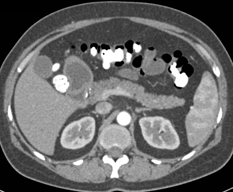 Focal Fatty Infiltration of the Pancreas Simulates a Mass - CTisus CT Scan