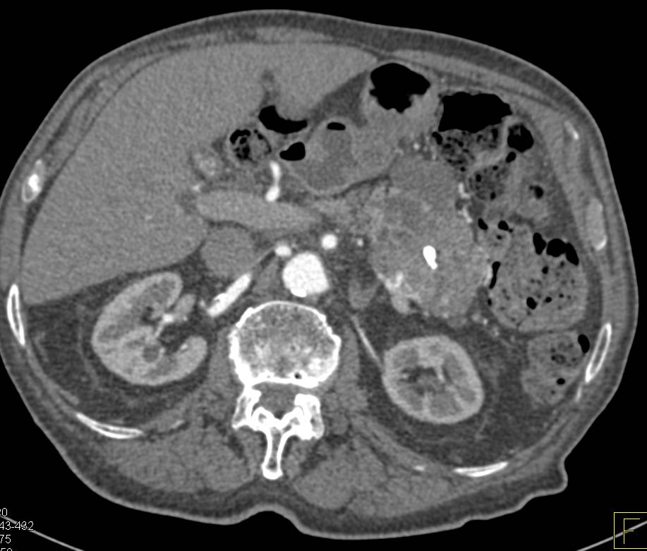 Serous Cystadenoma of the Tail of the Pancreas. The Lesion Can Be Confused with a Neuroendocrine Tumor - CTisus CT Scan