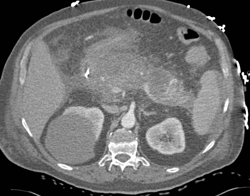 Acute Pancreatitis - CTisus CT Scan