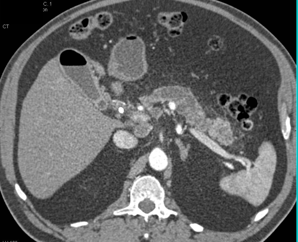 Pancreatic Cancer with Common Bile Duct (CBD) Stent and Dilated Pancreatic Duct. Duodenal Lipoma is also seen - CTisus CT Scan