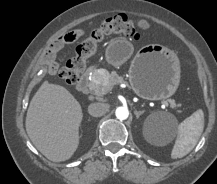 Neuroendocrine Tumor in the Head of the Pancreas - CTisus CT Scan