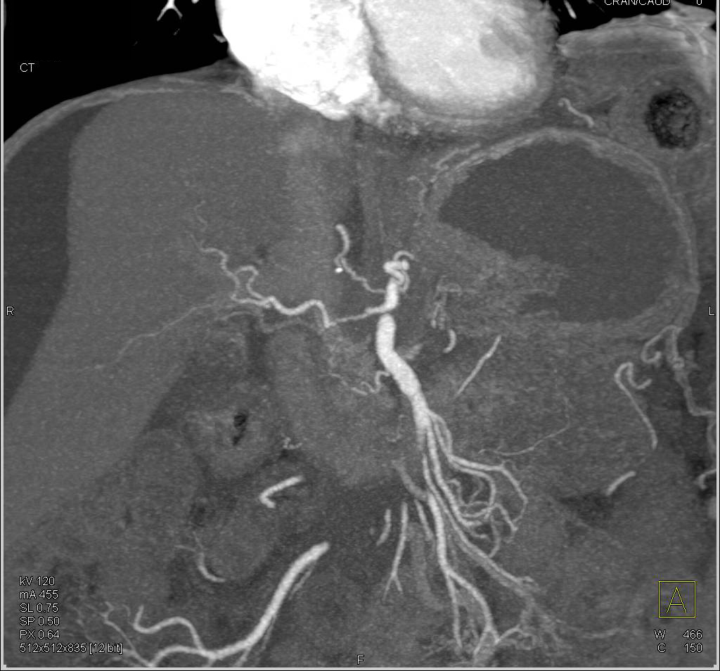 Pancreatic Cancer Infiltrates the Pancreatic Bed with Arterial and Venous Encasement - CTisus CT Scan