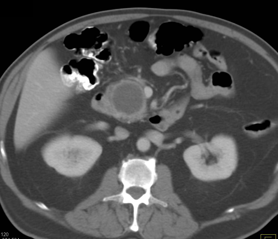 Serous Cystadenoma of the Pancreas - CTisus CT Scan