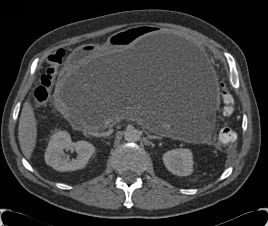 Large Pseudocyst in Lesser Sac due to Pancreatitis - CTisus CT Scan