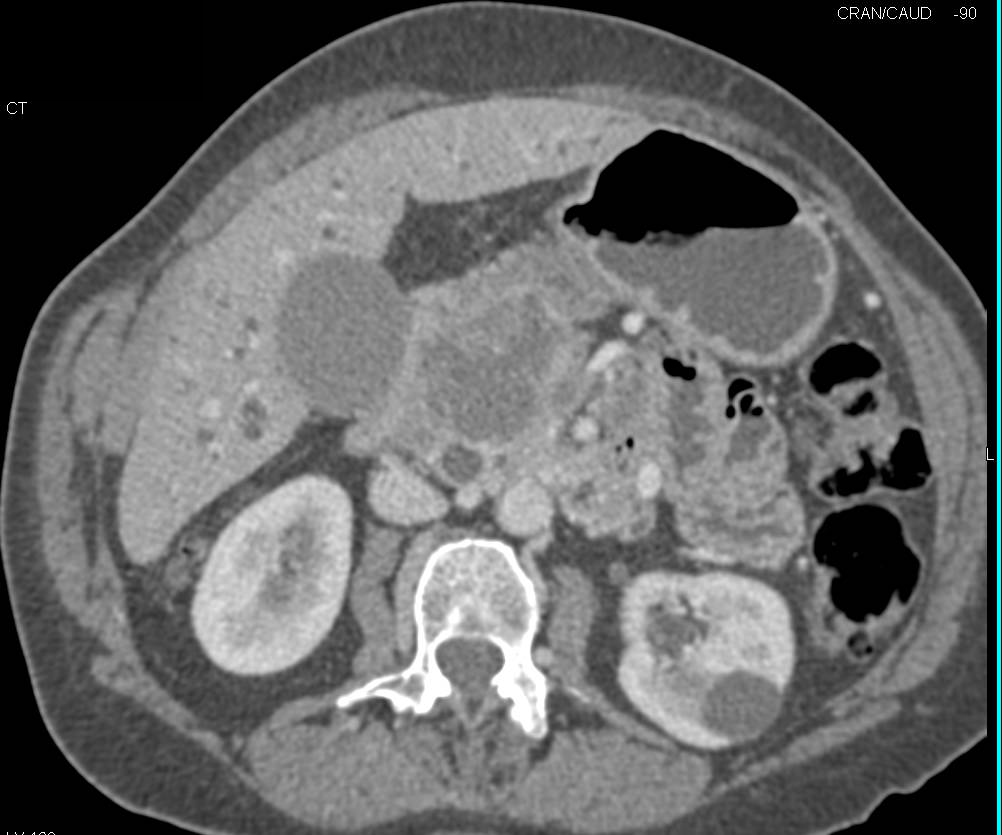 Necrotic Adenocarcinoma of the Pancreas Occludes the Portal Vein and Superior Mesenteric Vein (SMV) - CTisus CT Scan