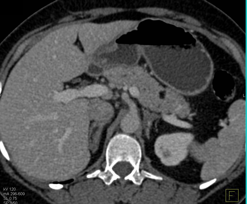 Intraductal Papillary Mucinous Neoplasm (IPMN) and Lipoma of the Pancreas - CTisus CT Scan