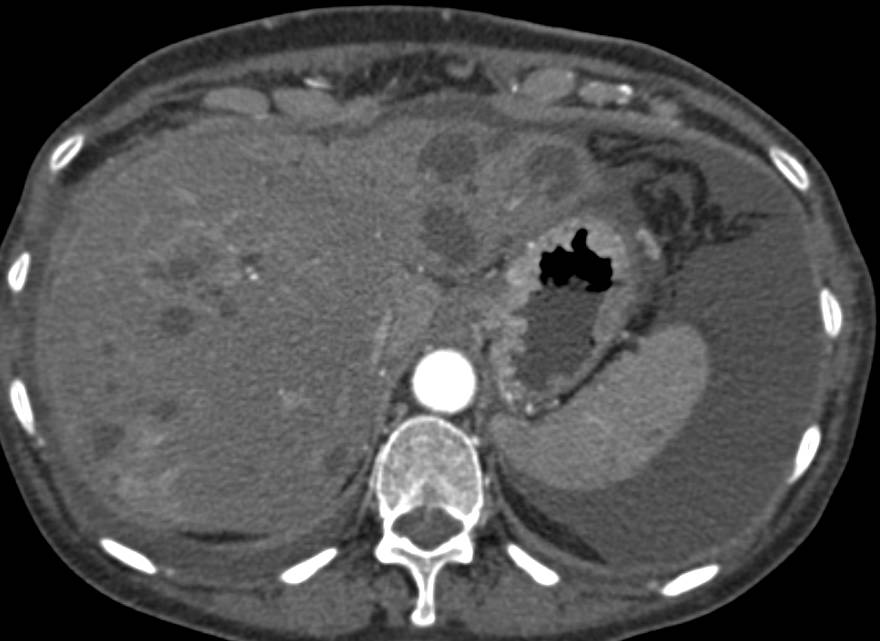 Carcinoma of the Body of the Pancreas with Carcinomatosis and Liver Metastases - CTisus CT Scan