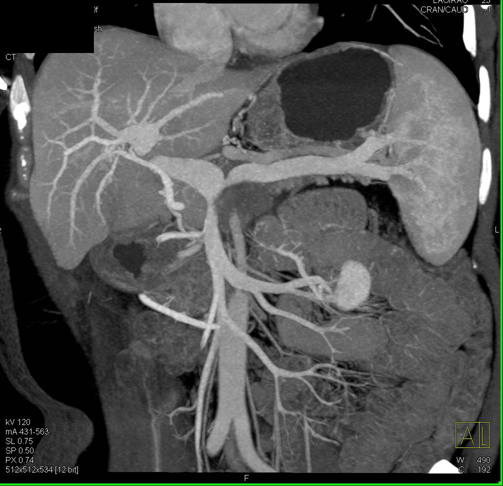 Pancreatic Cancer Infiltrates the Pancreatic Bed Portal Venous and Superior Mesenteric Vein (SMV) Encasement - CTisus CT Scan