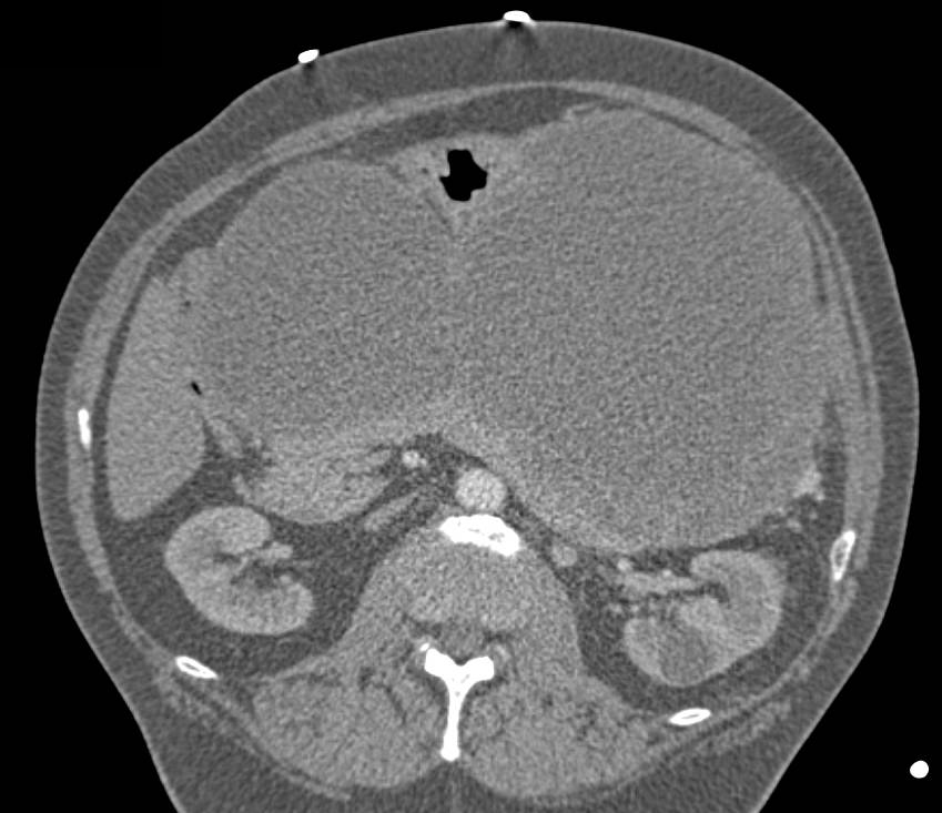 Large Pancreatic Pseudocysts - CTisus CT Scan