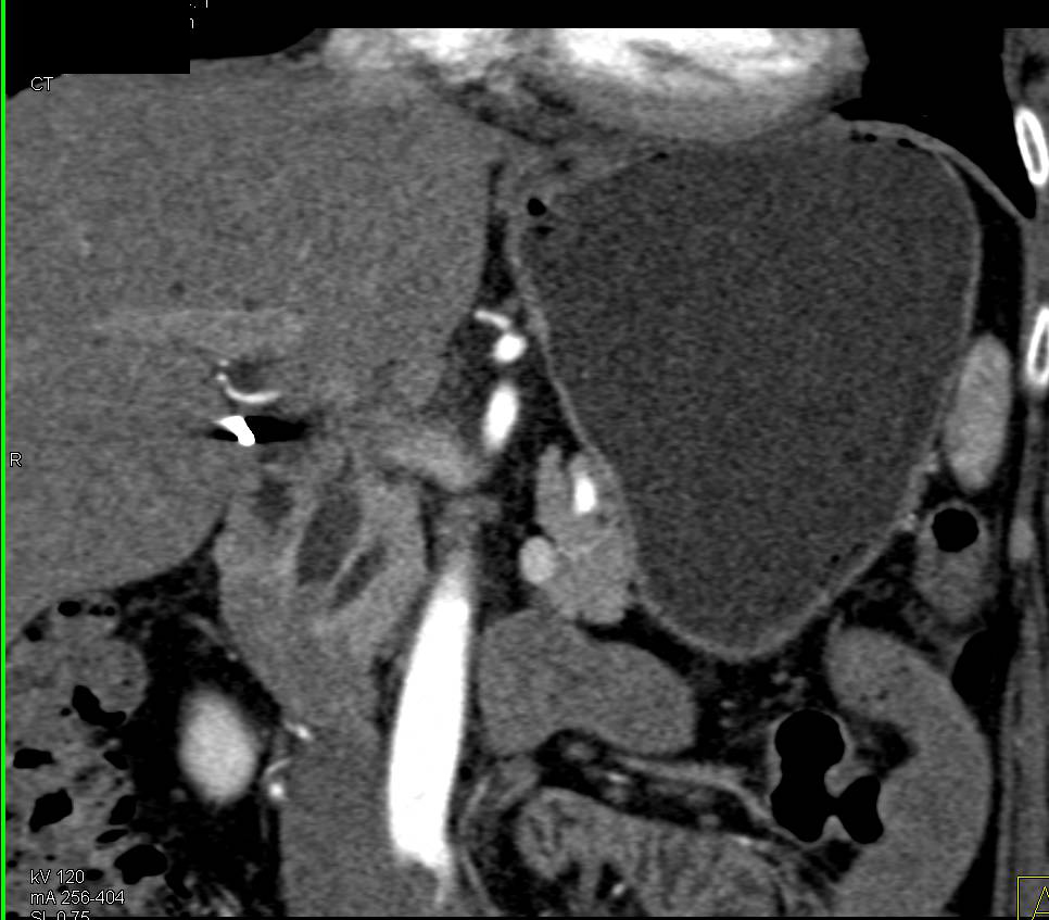 1 cm Ampullary Adenocarcinoma - CTisus CT Scan