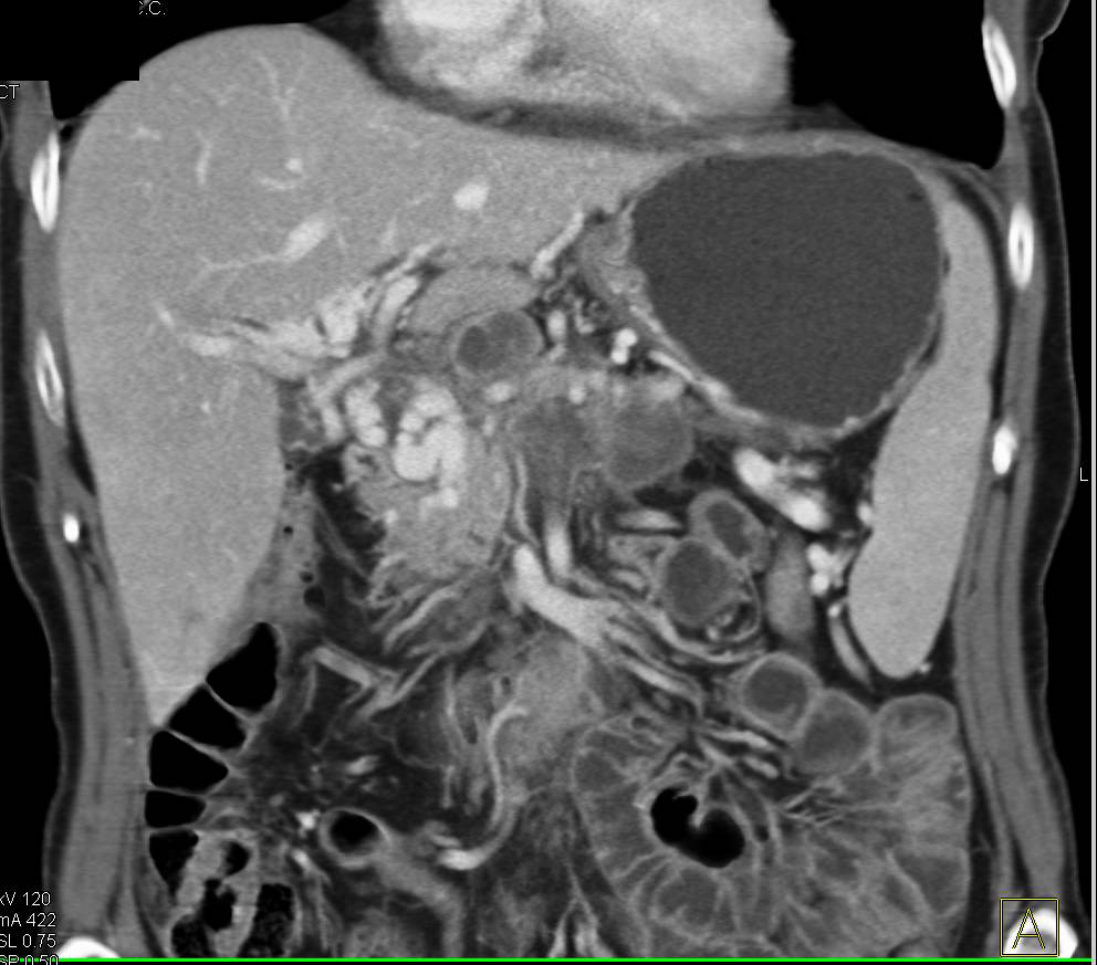 Pancreatic Cancer with Liver Metastases and Portal Vein Occlusion (CTPV) - CTisus CT Scan