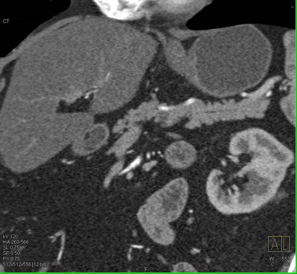 Intraductal Papillary Mucinous Neoplasm (IPMN) of the Pancreas - CTisus CT Scan