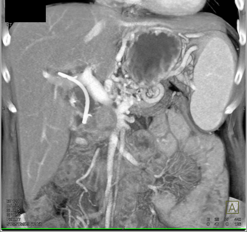 Pancreatic Cancer Arose in an Intraductal Papillary Mucinous Neoplasm (IPMN) with Portal Vein Encasement - CTisus CT Scan