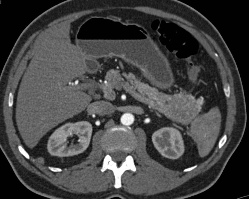 Neuroendocrine Tumor in Tail of Pancreas - CTisus CT Scan