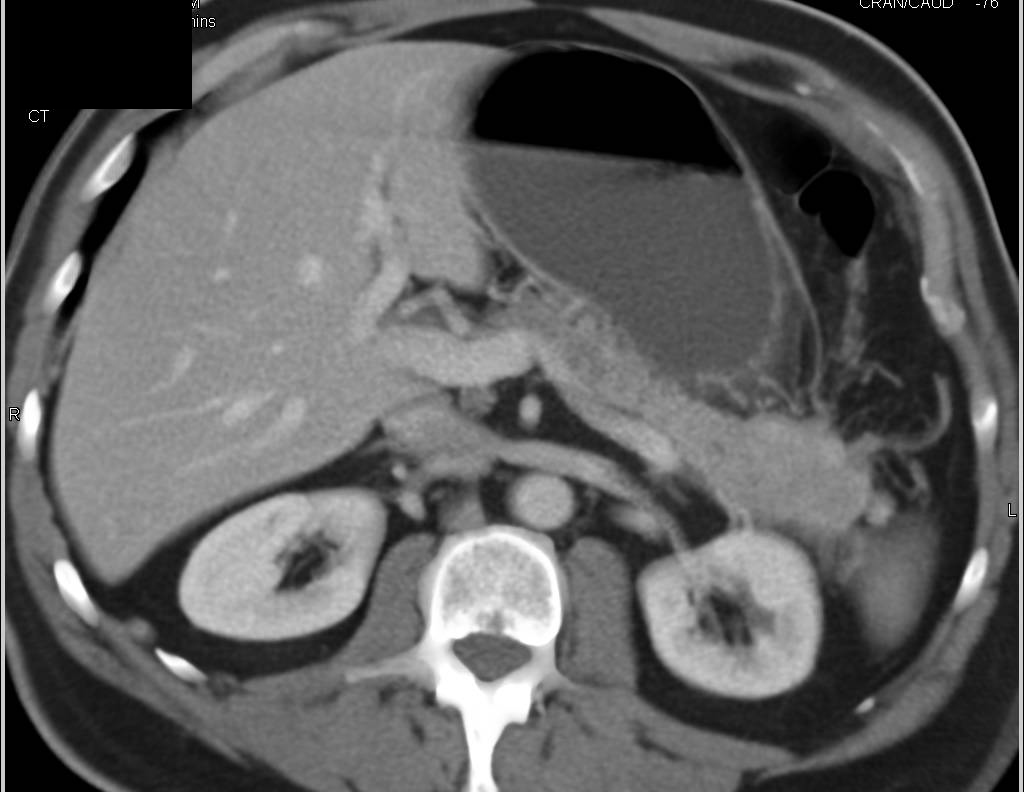 Neuroendocrine Tumor in Tail of Pancreas - CTisus CT Scan