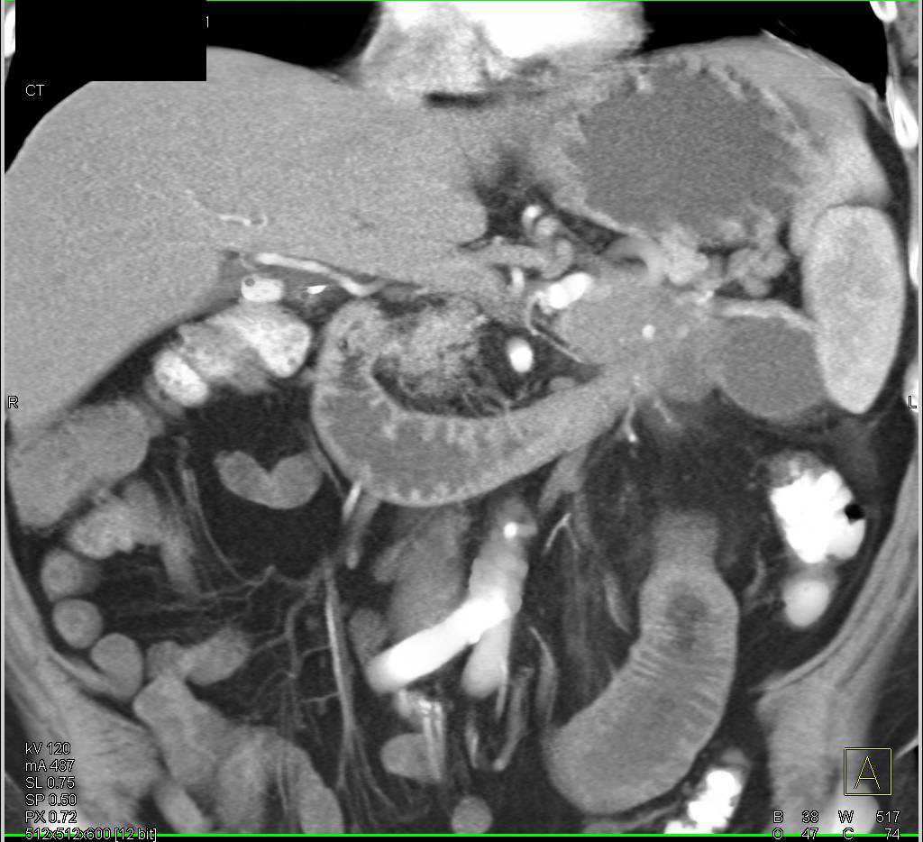 Carcinoma of the Tail of the Pancreas Invades the Duodenum at the Ligament of Treitz - CTisus CT Scan