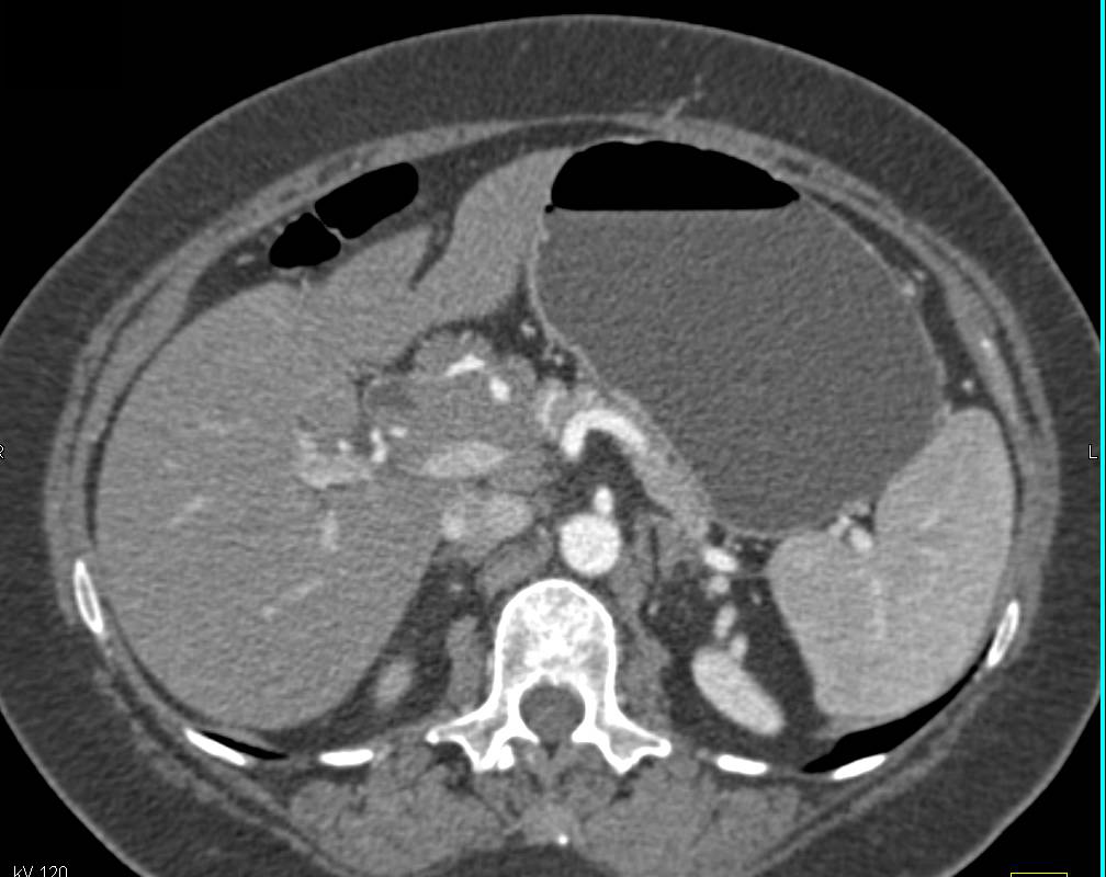 Pancreatic Cancer with a nice 3D Demonstration of Hepatic Artery Encasement - CTisus CT Scan