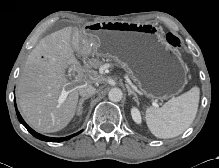 Infiltrating Pancreatic Cancer with Thrombus in the Right Portal Vein - CTisus CT Scan