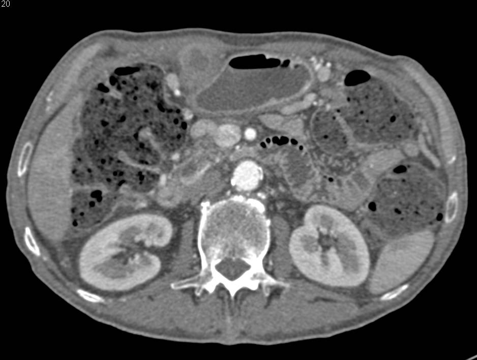 Recurrent Tumor Implant s/p Whipple - CTisus CT Scan