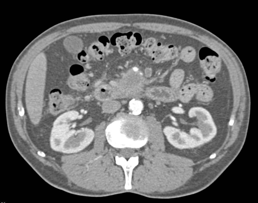 Adenocarcinoma of the Pancreas Encases Both The Superior Mesenteric Artery (SMA) and Superior Mesenteric Vein (SMV) - CTisus CT Scan