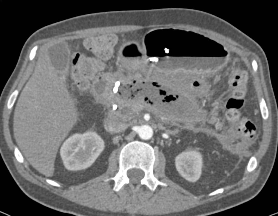 Pancreatic Necrosis and Abscess with Catheters in Place - CTisus CT Scan