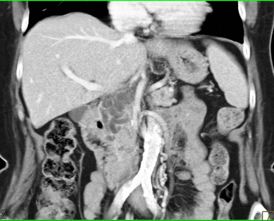 Complex Cystic Lesion in Head of Pancreas - CTisus CT Scan