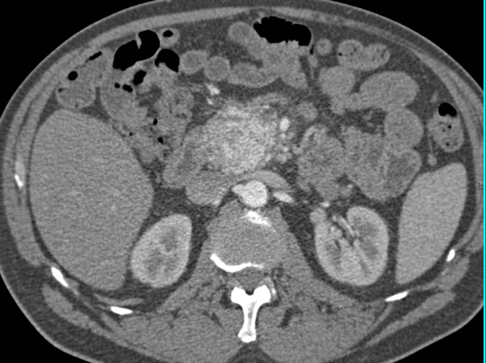 Neuroendocrine Pancreatic Mass with Collaterals - CTisus CT Scan