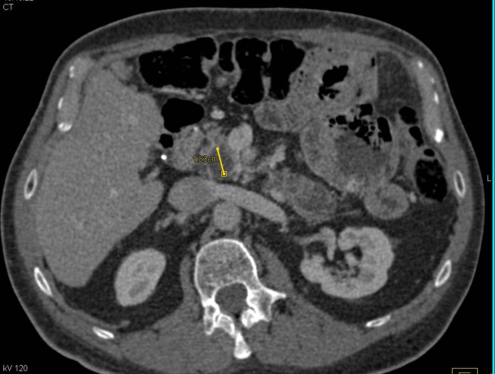 Intraductal Papillary Mucinous Neoplasm (IPMN) in Head of Pancreas - CTisus CT Scan