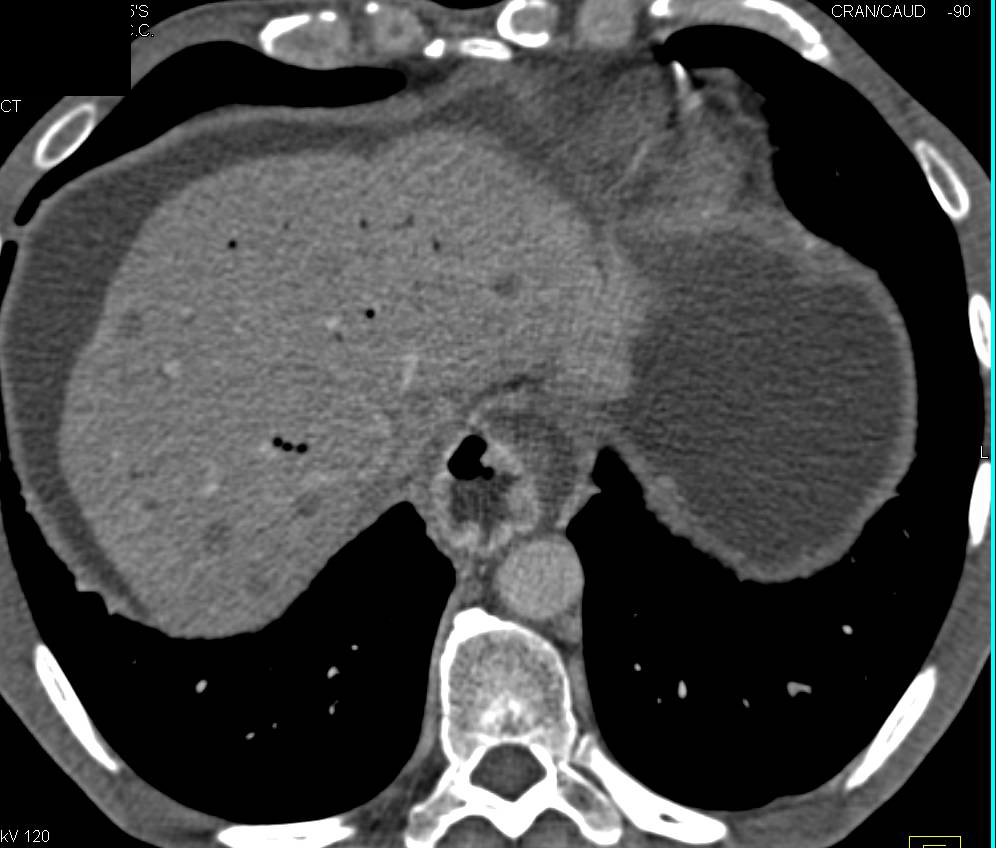 Pancreatic Cancer with Arterial and Venous Invasion and Liver Metastases - CTisus CT Scan
