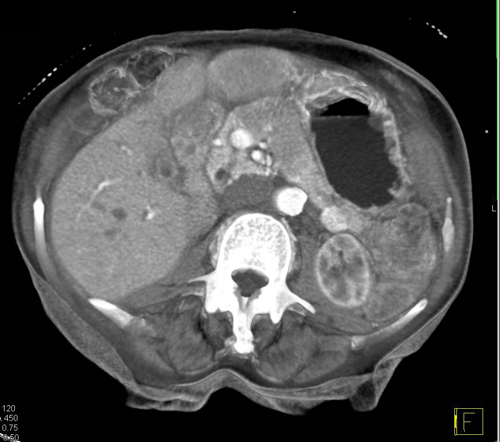 Renal Cell Carcinoma Metastatic to the Tail of the Pancreas - CTisus CT Scan