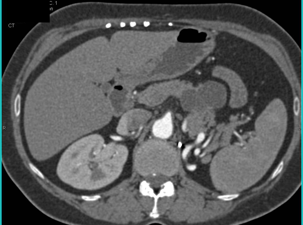 Serous Cystadenoma of the Pancreas in a Patient with Left Nephrectomy for Renal Cell Carcinoma - CTisus CT Scan
