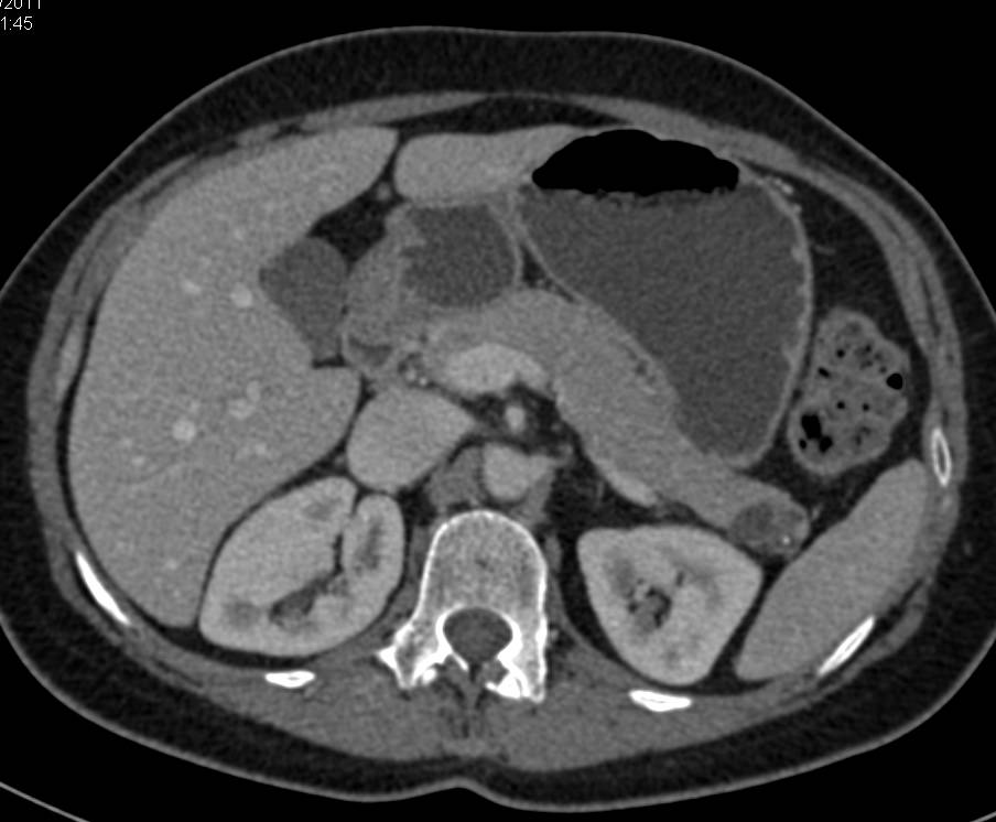 Serous Cystadenoma Tail of the Pancreas - CTisus CT Scan
