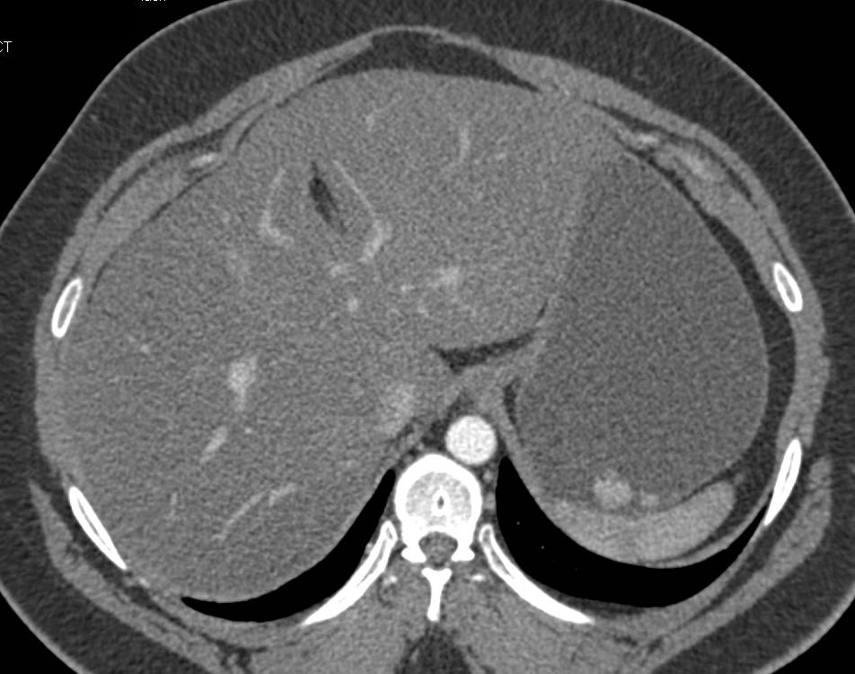 Neuroendocrine Tumor Body of Pancreas - CTisus CT Scan