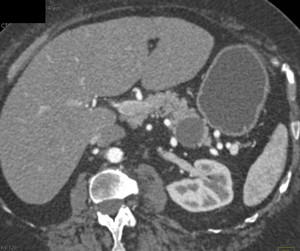MCN-Mucinous Cystic Neoplasm of the Pancreas - CTisus CT Scan