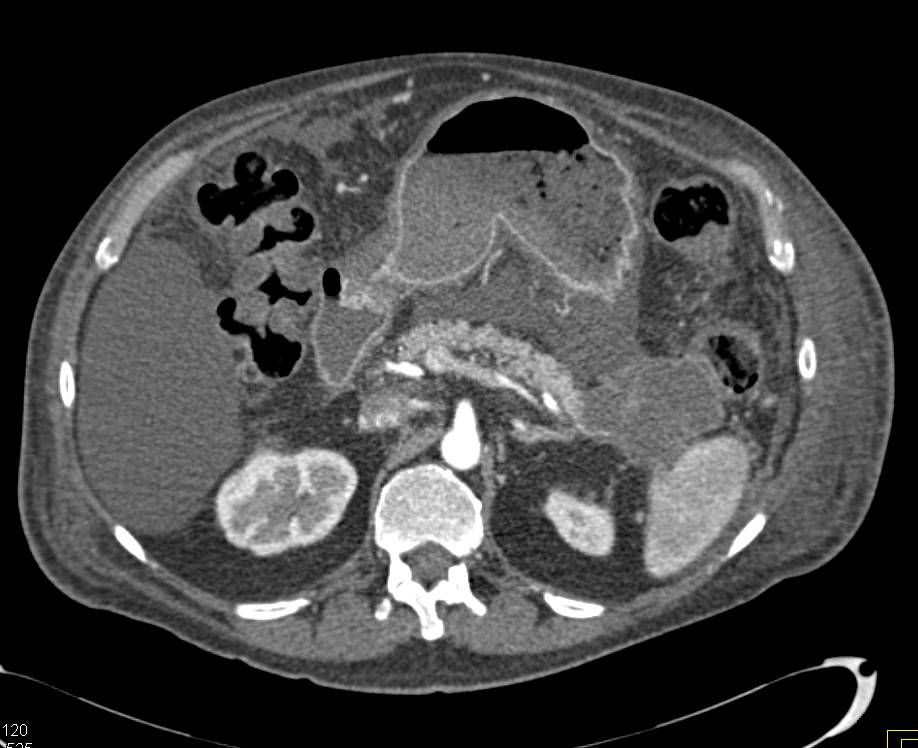 Carcinoma of the Tail of the Pancreas with Carcinomatosis - CTisus CT Scan
