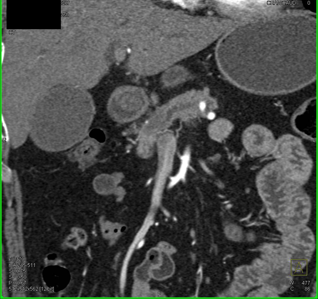 Subtle Adenocarcinoma of the Head of the Pancreas - CTisus CT Scan