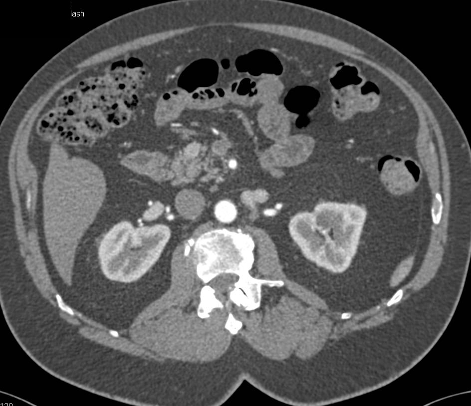 Incidental 1cm Neuroendocrine Tumor in the Head of the Pancreas - CTisus CT Scan