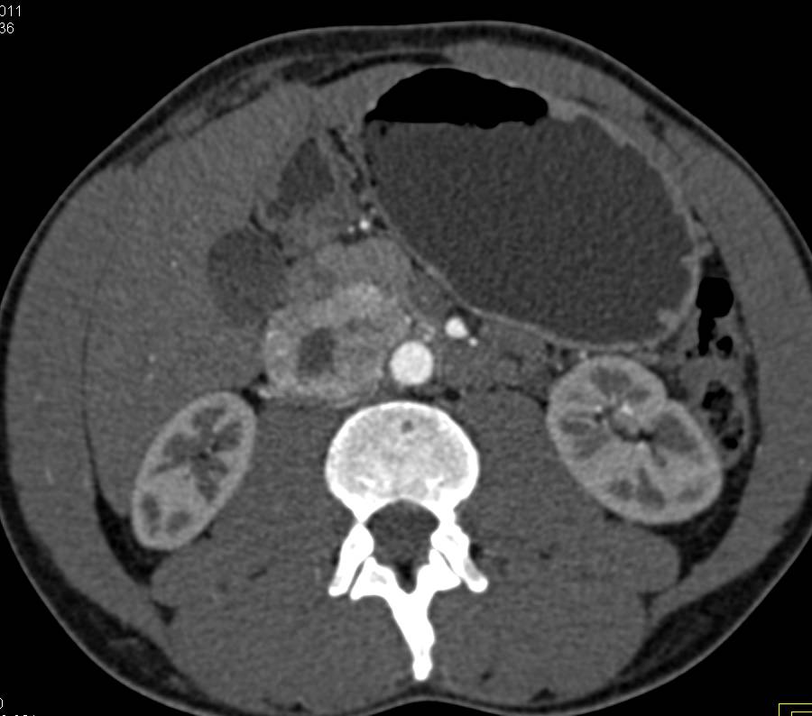 Paraganglioma Near Head of Pancreas Simulates a Pancreatic Mass - CTisus CT Scan