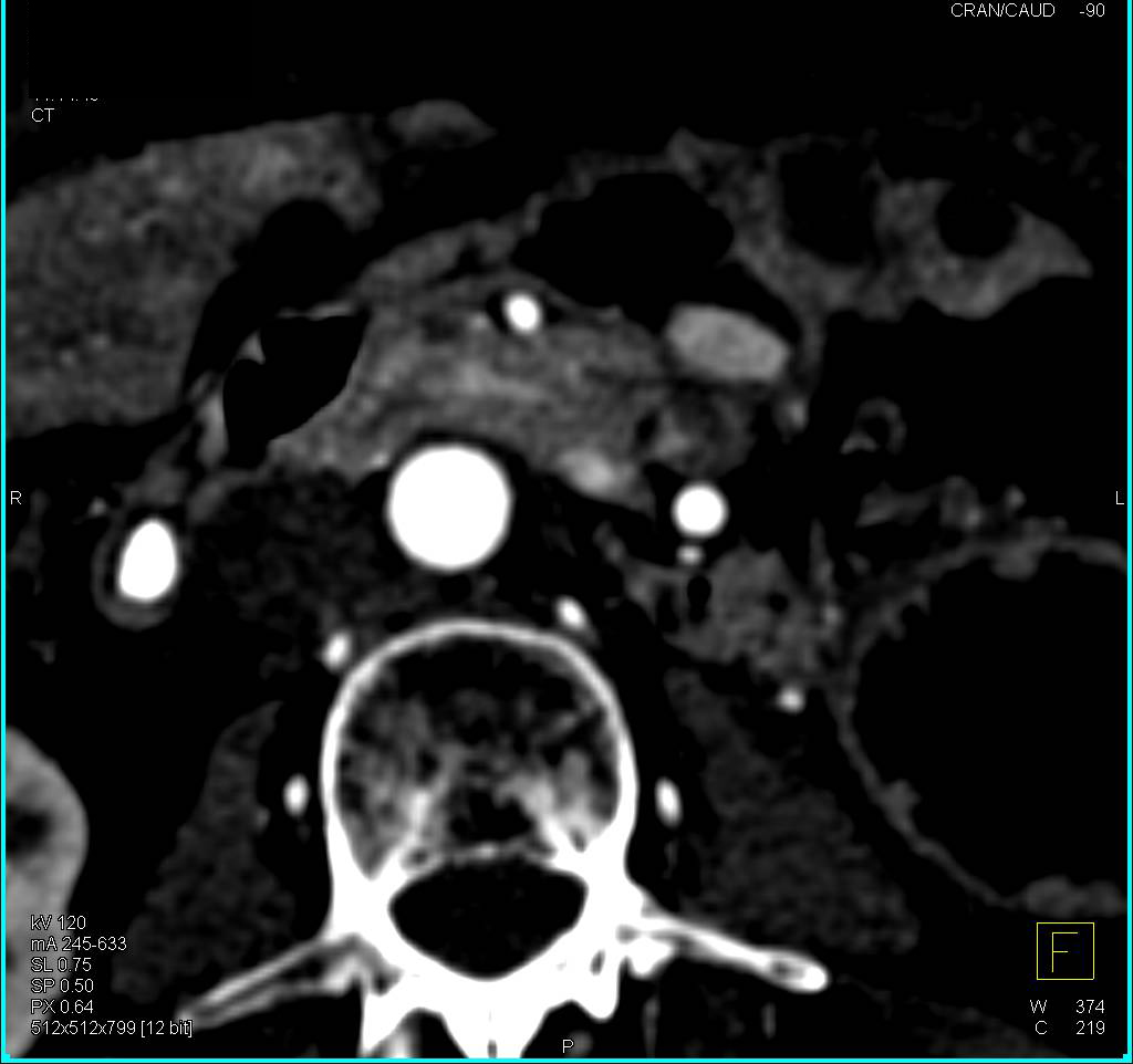 Under 1cm Neuroendocrine Tumor - CTisus CT Scan