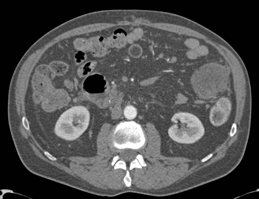 Pancreatic Cancer with Liver Metastases and Carcinomatosis - CTisus CT Scan