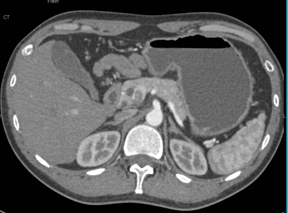 Intraductal Papillary Mucinous Neoplasm (IPMN) in Head of Pancreas - CTisus CT Scan