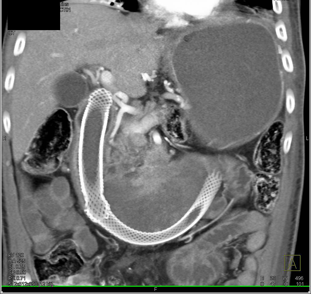 Pancreatic Cancer Invades the Duodenum. Stents Placed in the Duodenum - CTisus CT Scan