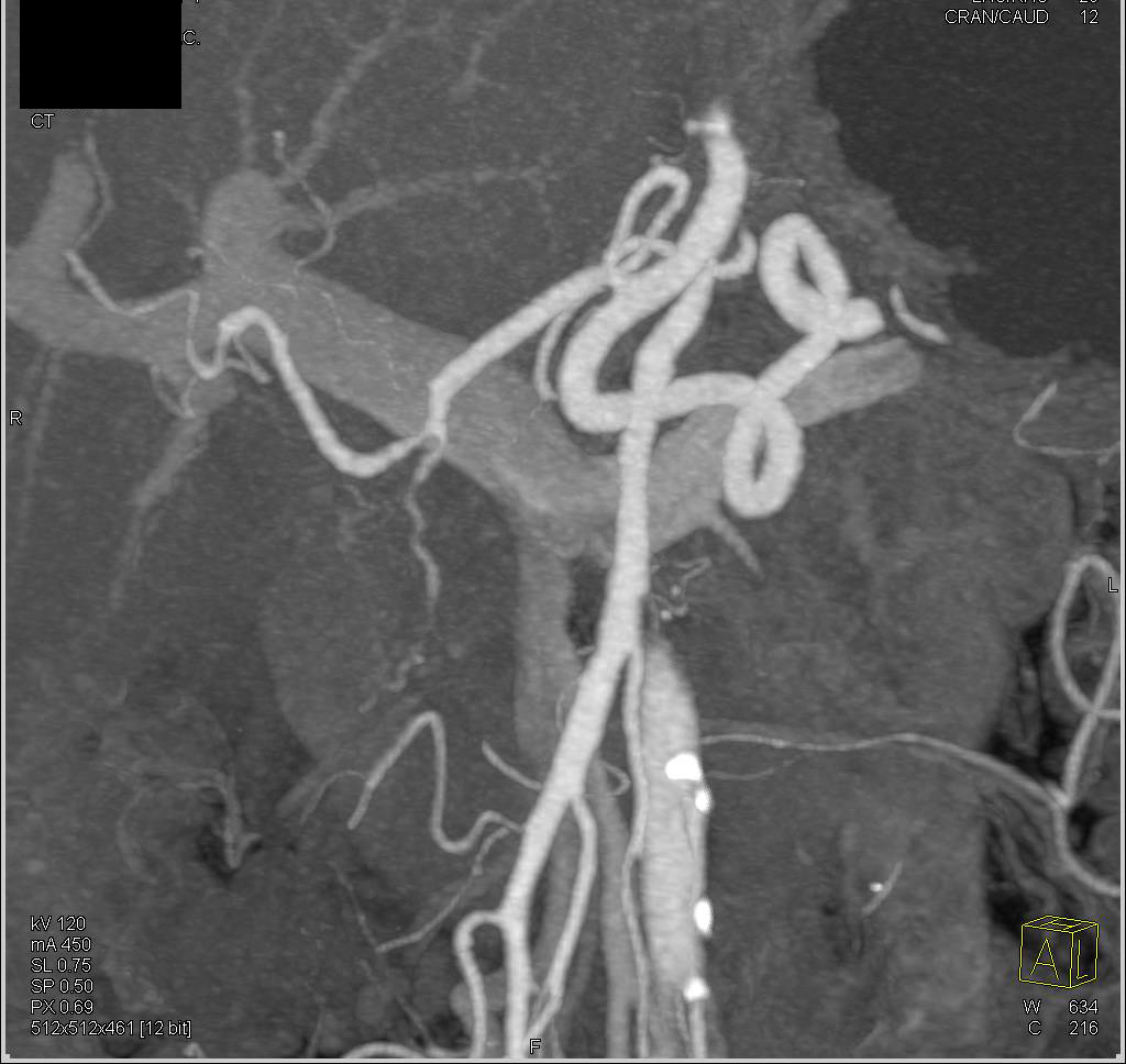 Pancreatic Cancer Encases the Hepatic Artery and the Gastroduodenal Artery (GDA) - CTisus CT Scan