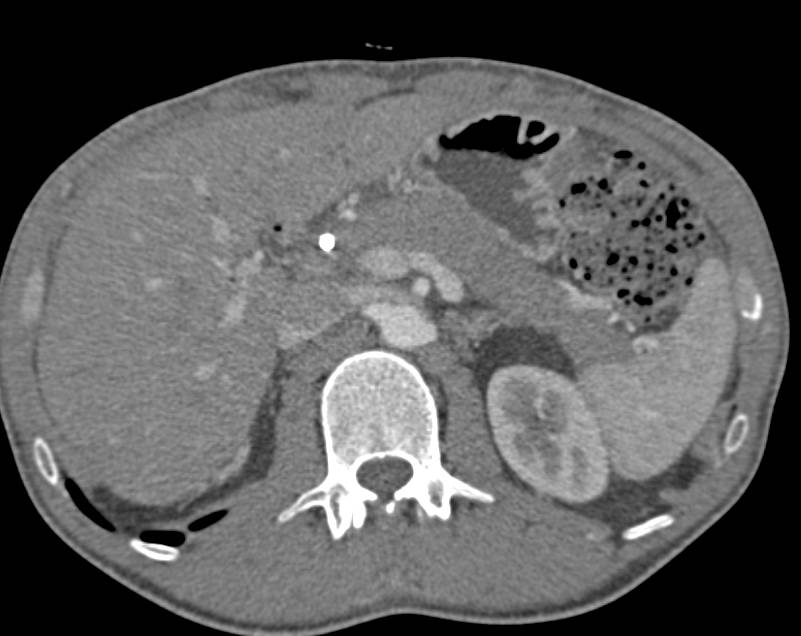 Autoimmune Pancreatitis - CTisus CT Scan