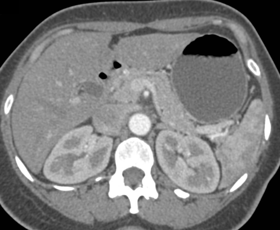 Intraductal Papillary Mucinous Neoplasm (IPMN) Tail of the Pancreas - CTisus CT Scan