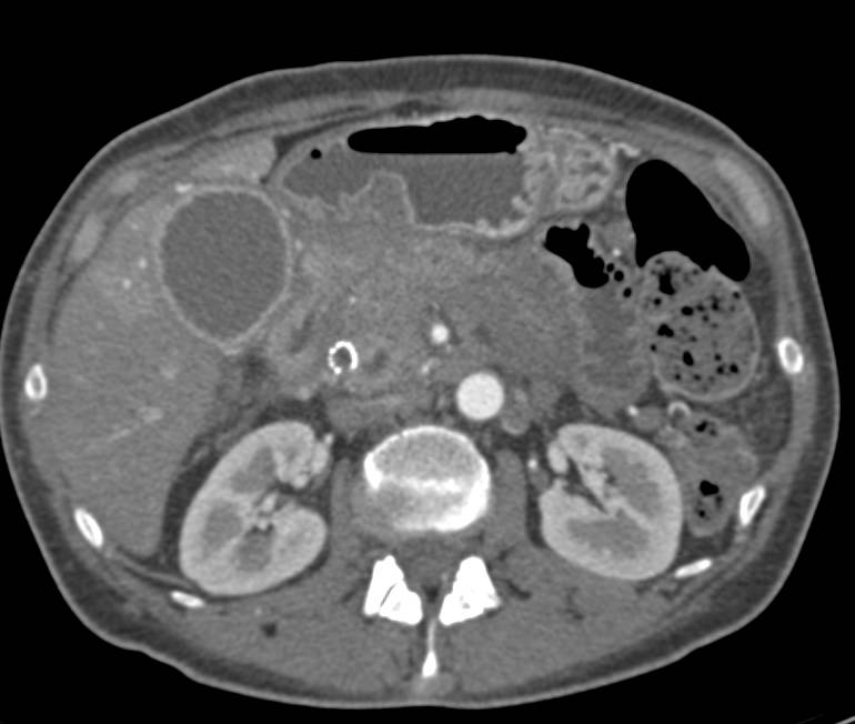 Pancreatic Cancer Infiltrates the Peri-Pancreatic Bed with Increased Enhancement of the Gallbladder - CTisus CT Scan