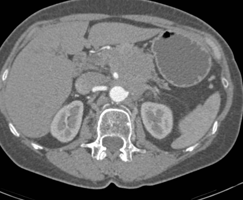 Infiltrating Adenocarcinoma of the Pancreas Encases Celiac and Superior Mesenteric Artery (SMA) and Occludes Splenic Vein - CTisus CT Scan